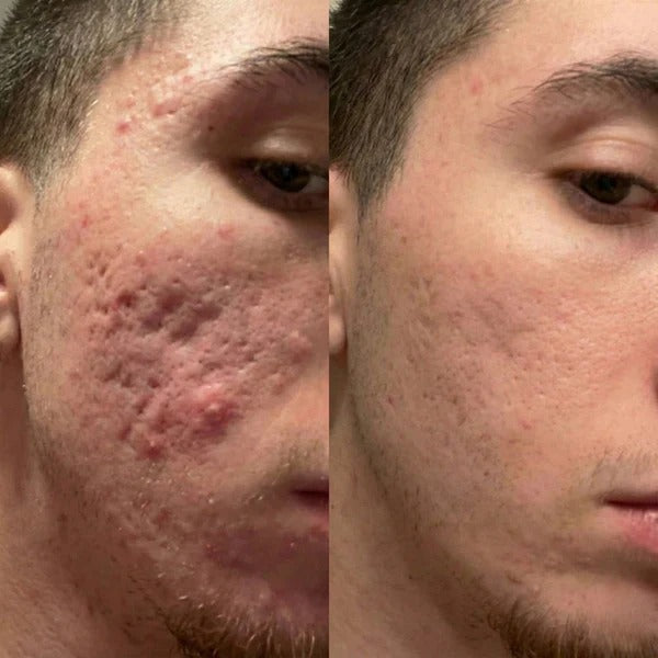 Before and after comparison of a person's face with acne on the left and clear skin on the right.