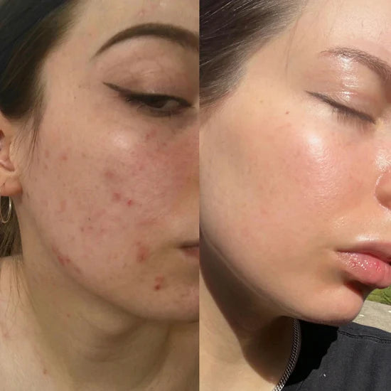 Before and after comparison of a person's face with acne on the left and clear skin on the right.
