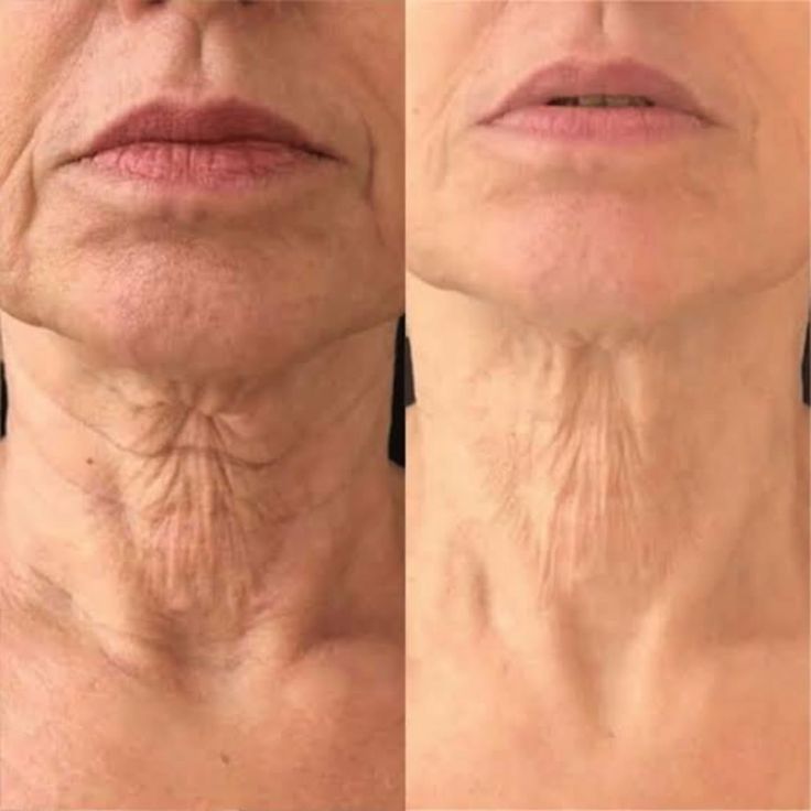 Before and after comparison of a person's neck skin with visible lines and wrinkles.