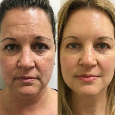 Before and after comparison of a woman's face with visible skin improvement.